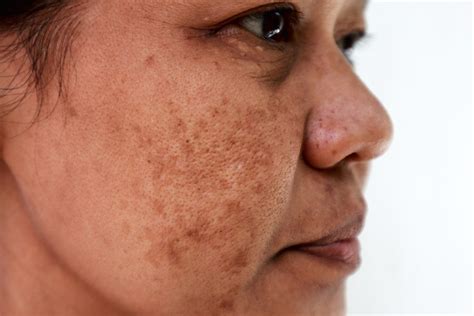 Melasma skin treatment in Exeter & Torquay in Devon.