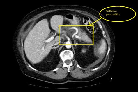 Acute pancreatitis CT - wikidoc