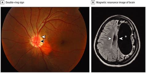 Optic Nerve Hypoplasia in the Eye and Beyond | Neuro-ophthalmology ...