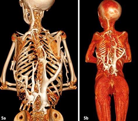 The stone man disease: fibrodysplasia ossificans progressiva : r/medizzy