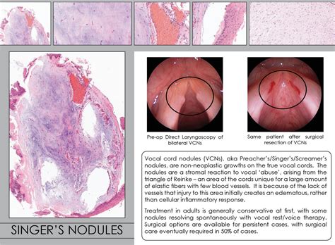 Singer's Nodules Pathology | Iowa Head and Neck Protocols