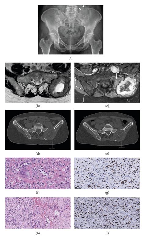 Case 1, a 54-year-old female with a GCTB in the left ilium. (a) X-ray... | Download Scientific ...