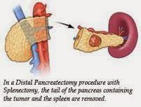 OTMANAGE: Distal Pancreatectomy