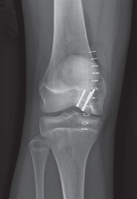 Osteochondritis Dissecans of the Knee: Differential Diagnosis, Approaches to Treatment ...