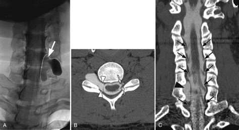 Tarlov Cyst | Radiology Key