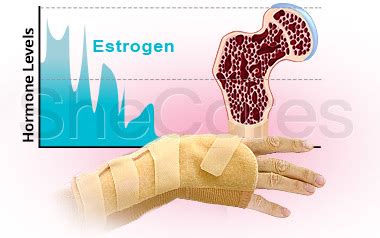 Osteoporosis | SheCares