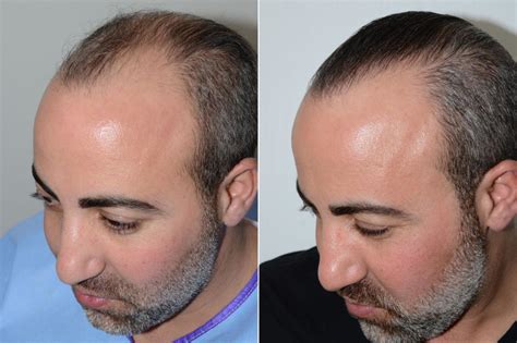 Hair Transplants for Men photos | Miami, FL | Patient59522