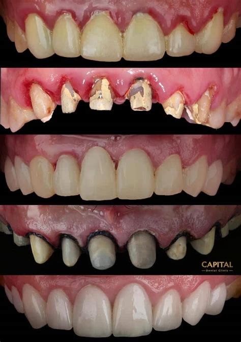 Full mouth rehabilitation - MyZerodonto