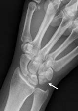 Triquetrum Fracture - Hand - Orthobullets