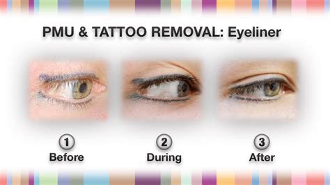 Permanent Makeup & Tattoo Removal - NPM Shop