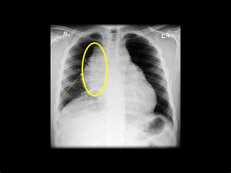 Primary mediastinal large B-cell lymphoma x ray - wikidoc