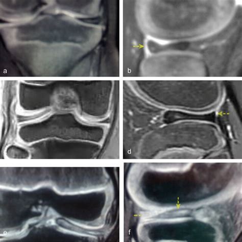 MRI and Arthroscopic images; discoid meniscus of the right knee;... | Download Scientific Diagram