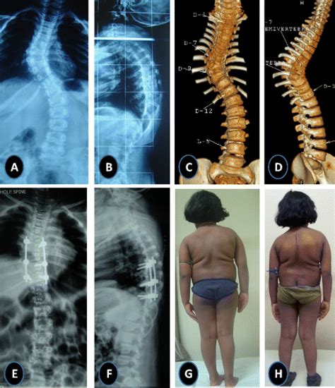 Four-year-old girl presented with hemivertebra at D7 and D9—note the ...