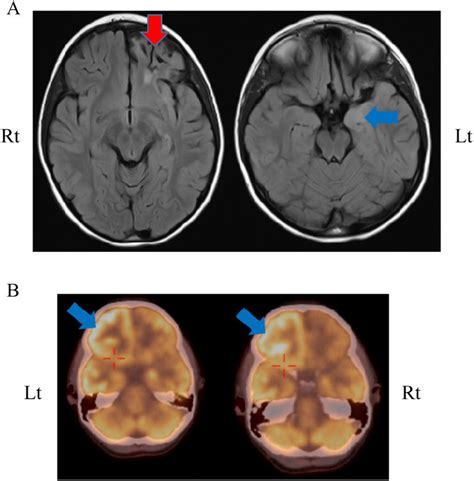 (A) Brain MRI. Encephalomalacia and gliotic changes involving the left ...