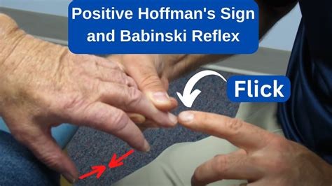 Hoffman's sign positive and Babinski reflex in MS patient - YouTube