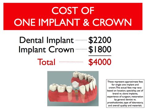 Cost Difference Between Dental Bridge and Dental Implant | Cost ...