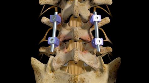 L4-5 Posterior Interbody Fusion - YouTube