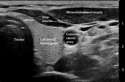 Normal Parathyroid Gland Ultrasound