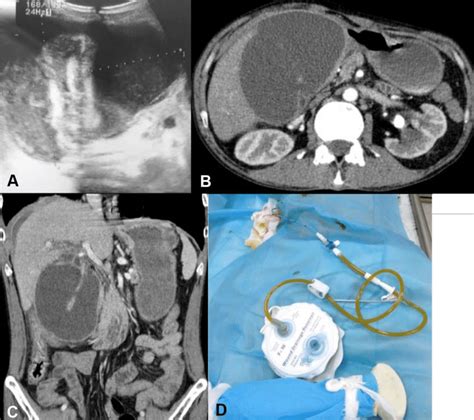 -Ultrasound (US) performed on day 17 demonstrated a diffuse gallbladder... | Download Scientific ...