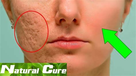 Natural Cure - How To Prevent And Fade Acne Scars Fast - YouTube