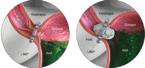 GERD Surgery in Knoxville, TN | Linx Reflux System