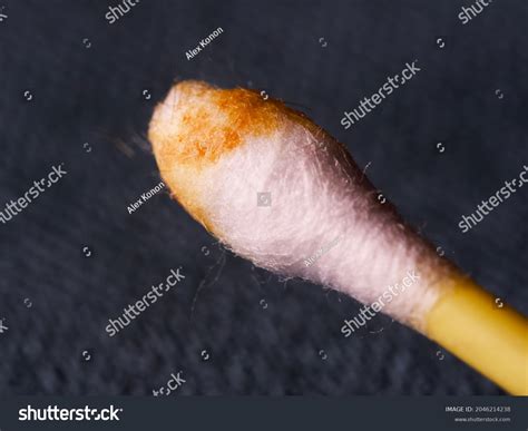 82 Earwax Photo Images, Stock Photos & Vectors | Shutterstock