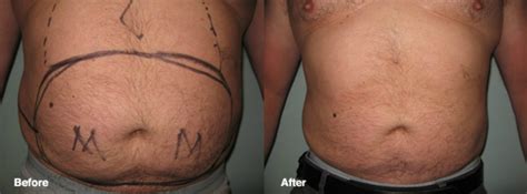 Lipo Photo Gallery | Smart Lipo Cleveland