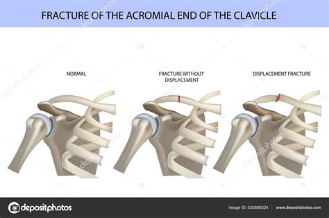 Fracture of the acromial end of the clavicle, medical vector ...