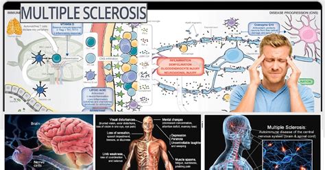 Multiple Sclerosis Symptoms Causes And Treatment