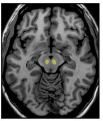 MRI Scans (Brainstem) flashcards | Quizlet