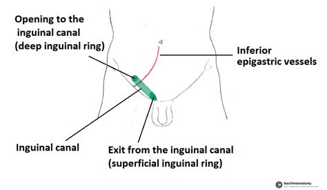 learnmore: Hernia