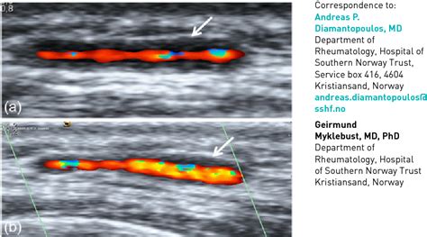 Figure 1 from Long-term inflammation in the temporal artery of a giant ...