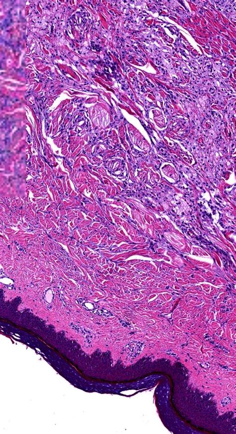 Pathology of Tendinous Xanthoma | Histology slides, Pathology, Blog