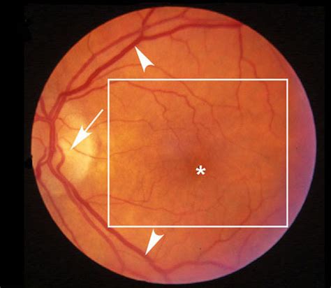 Figure 1. [Normal macula of an elderly...]. - Webvision - NCBI Bookshelf