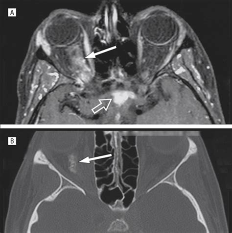 Optic Nerve Sheath Meningiomas in Patients With Neurofibromatosis Type 2 | Congenital Defects ...