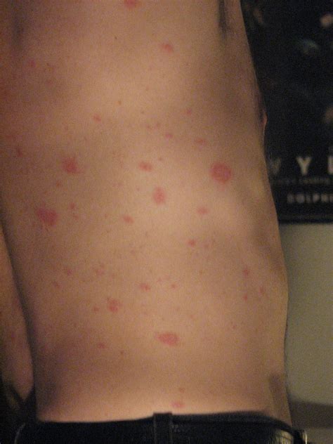 Pityriasis Rosea – Pictures, Causes, Symptoms and Treatment