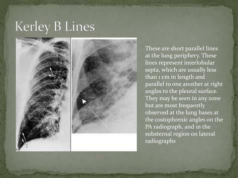 Kerley B Lines Pulmonary Edema