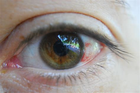 Eye Hemorrhage | Eye Hemorrhage Day 3 4 Days of the Healing … | Flickr