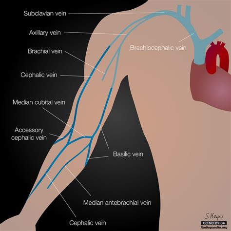 Αποτέλεσμα εικόνας για upper limb vein thrombosis | Vein thrombosis ...