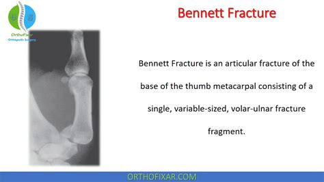 Bennett Fracture Overview | OrthoFixar 2024