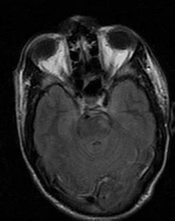 Diffuse Axonal Injury-MRI - Sumer's Radiology Blog