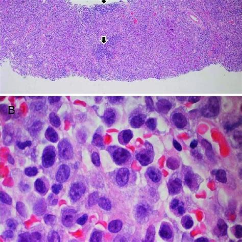 Bone marrow trephine biopsy showing (A) marked hypercelluarity with ...