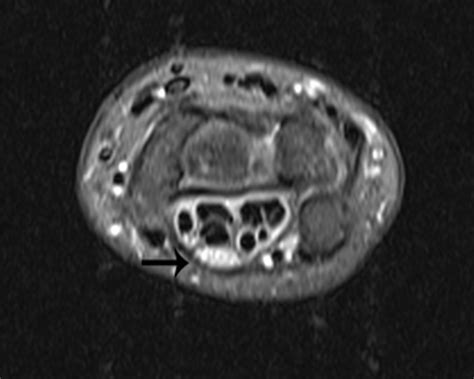 A New Neurological Sign Shows Severity of Carpal Tunnel Syndrome