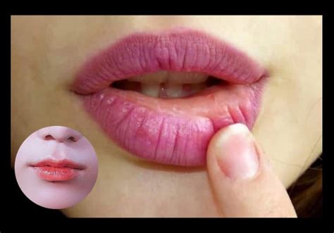 What are the dry lips causes, and how to care for lips? - healthy life ...