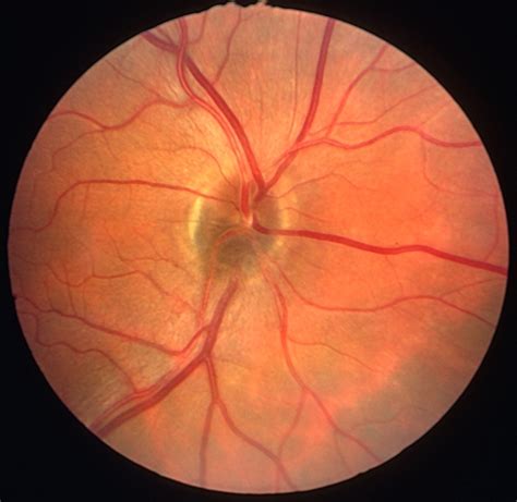 Optic nerve melanocytoma case 4 - image 1 - Retina Image Bank