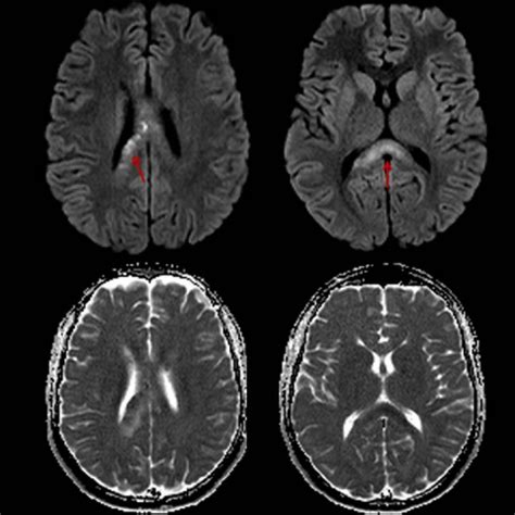 Diffuse axonal injury: CT and MRI typical findings | Eurorad