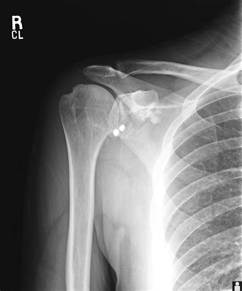 Glenohumeral Arthritis - Shoulder & Elbow - Orthobullets