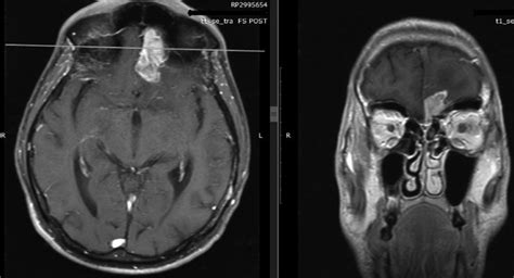 preoperative (before the second surgery) contrast-enhancing MrI; [on... | Download Scientific ...