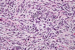 Dermatofibrosarcoma protuberans - Libre Pathology