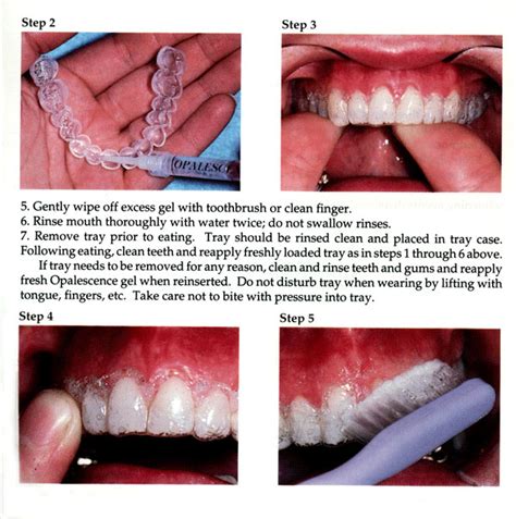 tips using teeth whitening trays